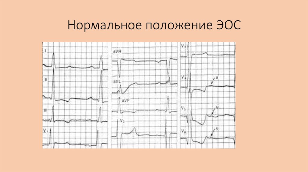 Нормальное положение. Нормальная ЭОС на ЭКГ. ЭКГ-признаки нормального положения ЭОС. Нормальное положение ЭОС на ЭКГ. Нормальное положение электрической оси.