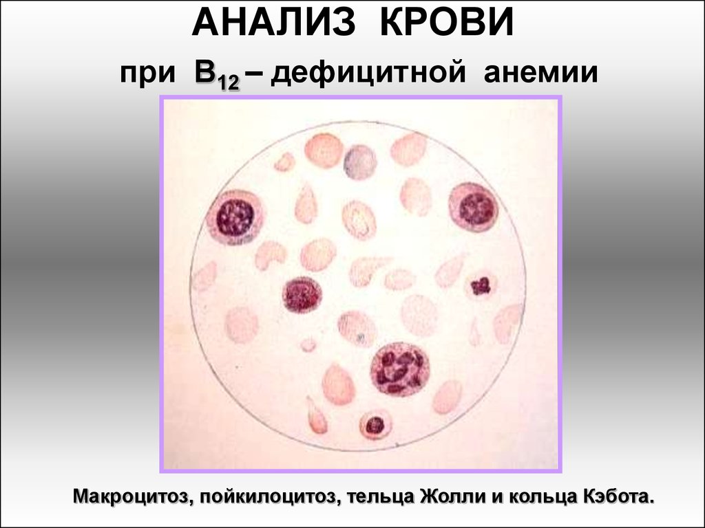 Кольца кебота в эритроцитах