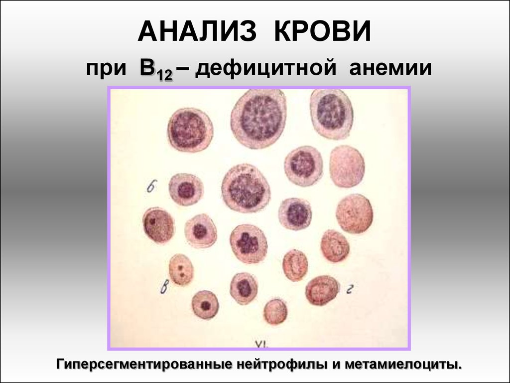 Дефицитная анемия. ОАК при б12 дефицитной анемии. Для в12 - дефицитной анемии нейтрофилы. В12 дефицитная анемия анализ. В12 дефицитная анемия гемограмма.