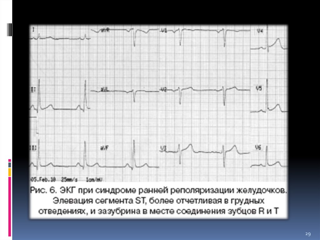Неспецифические изменения нижней стенки. Ранней реполяризации желудочков кардиограмма. Реполяризация миокарда желудочков ЭКГ. ЭКГ при синдроме ранней реполяризации. Элевация сегмента St на ЭКГ.