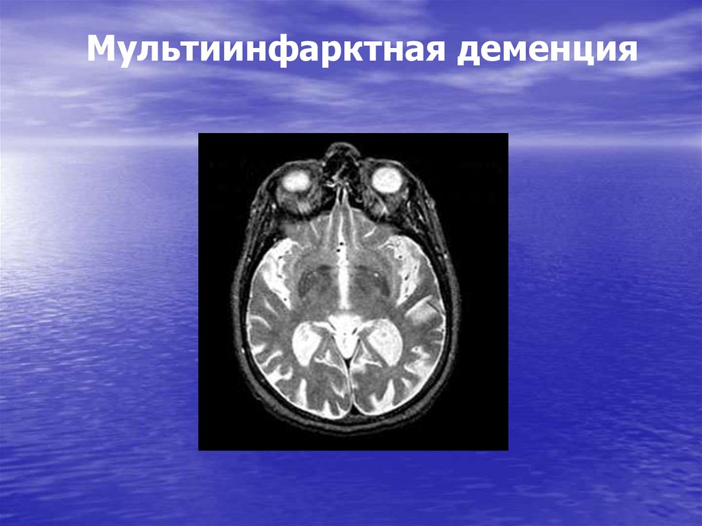 Мультиинфарктная деменция. Мультиинфарктная деменция на кт. Мультиинфарктное состояние головного мозга. Мультиинфарктная энцефалопатия кт. Прогрессирующая мультиинфарктная.