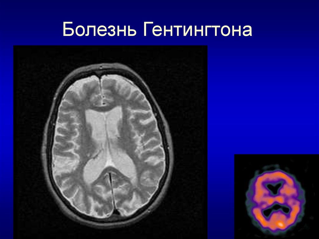 Болезнь гентингтона неврология презентация