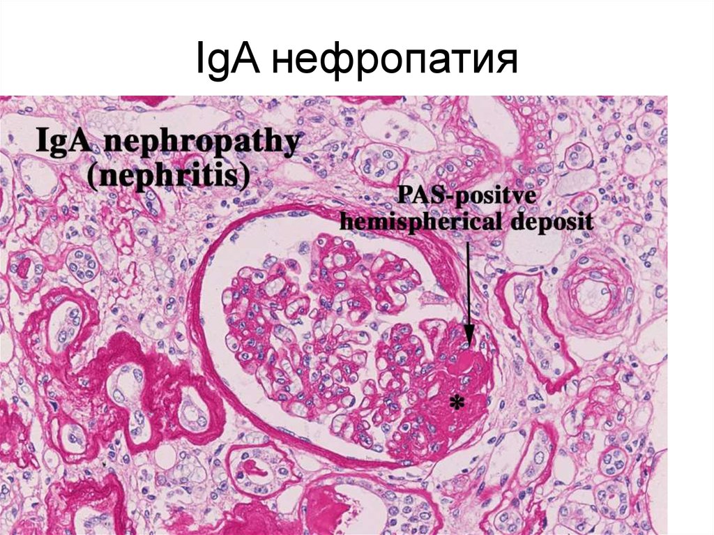 Берже болезнь презентация