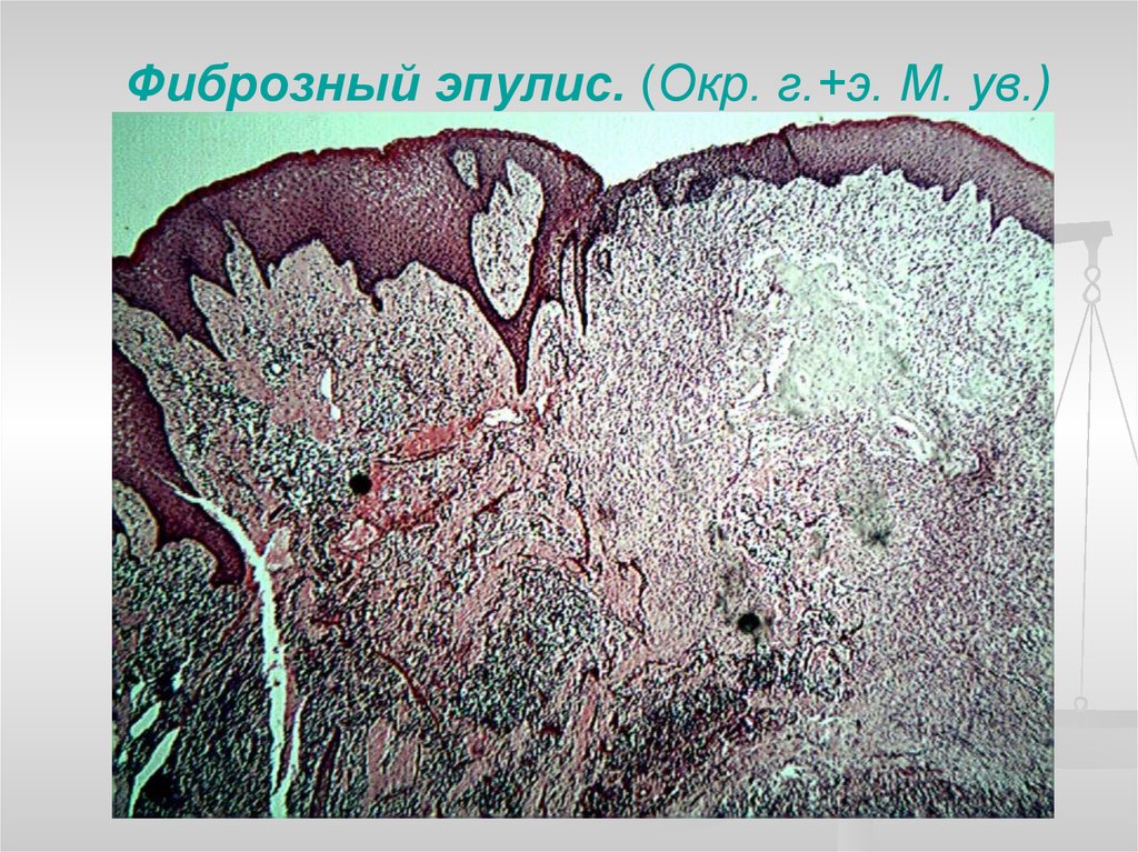 Картина фиброзных изменений. Гигантоклеточная гранулема гистология. Периферическая гигантоклеточная (репаративная) гранулема.