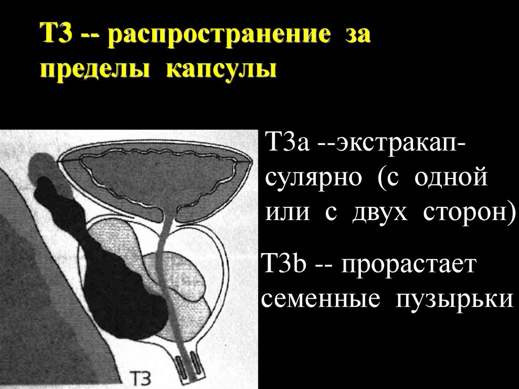 Предстательная железа размеры в норме у мужчин. Простата и семенные пузырьки. Опухоли семенных пузырьков. Капсула предстательной железы. Объемное образование предстательной железы.