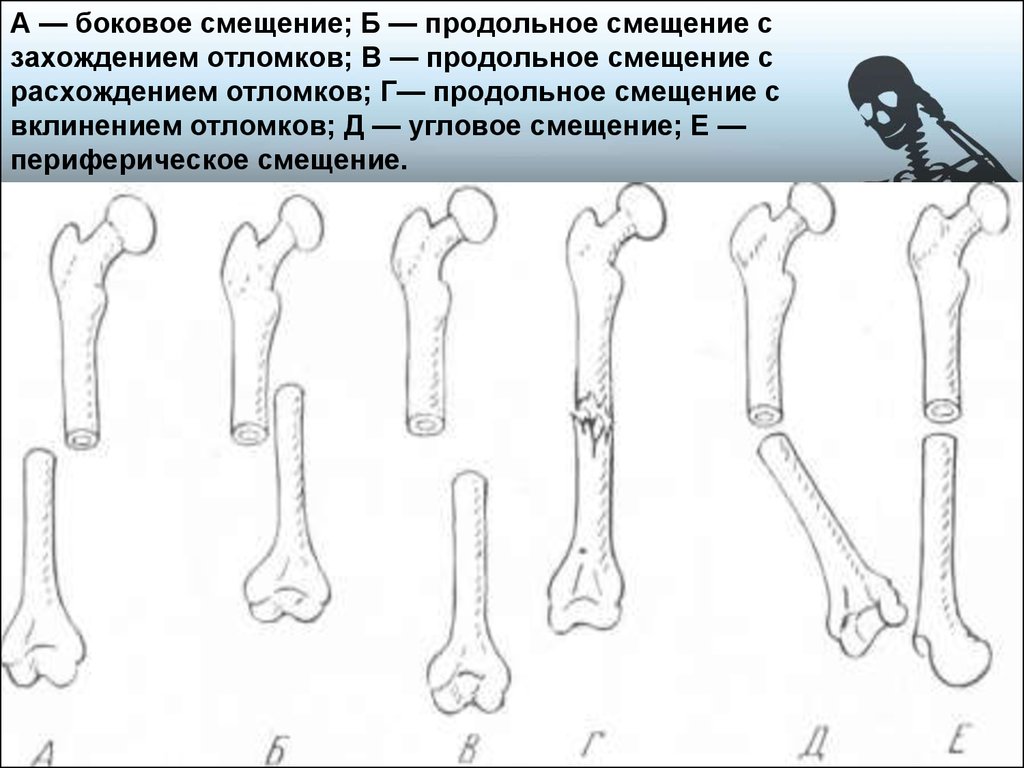 Кости угол. Смещение отломков перелома схема. Перелом кости со смещением отломков. Поперечный перелом с вклинением отломков. Схема переломов трубчатых костей.