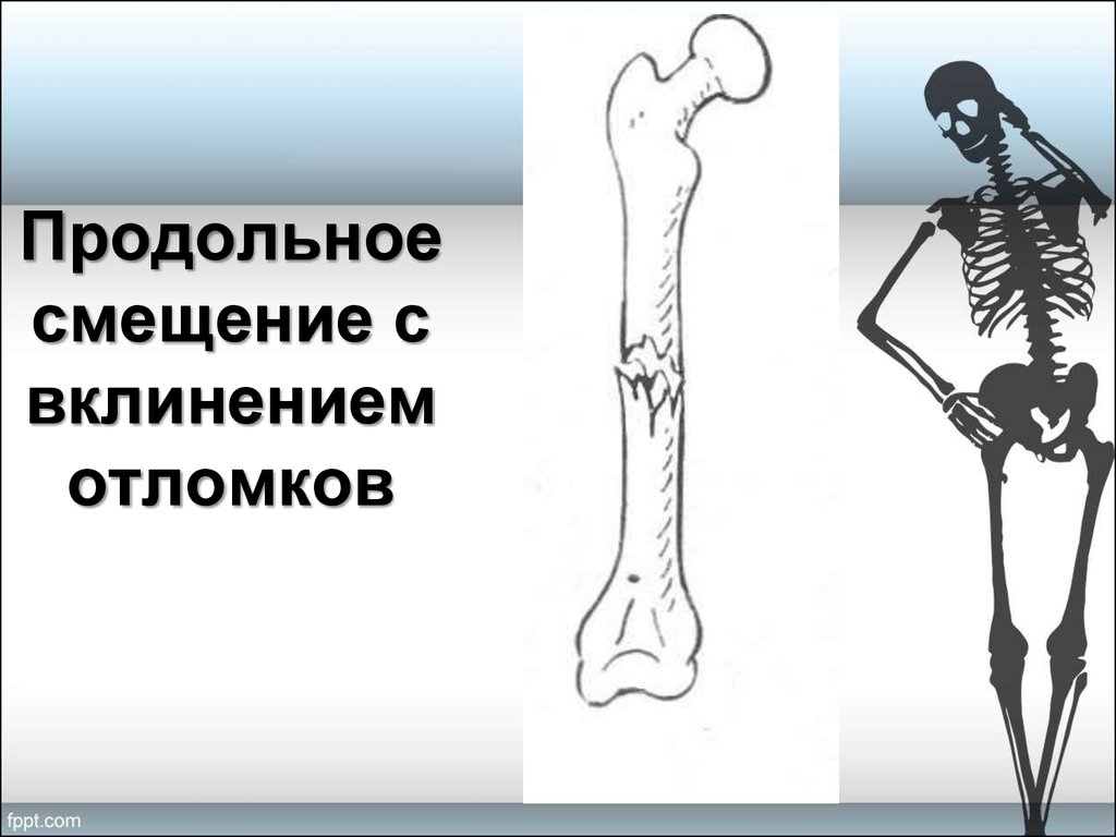 Смещение отломков кости. Поперечный перелом с вклинением отломков. Продольное смещение отломков.