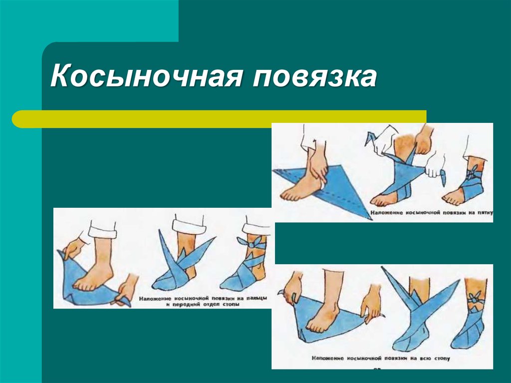 Косыночная повязка. Наложение косыночной повязки на стопу. Косыночная повязка на стопу алгоритм. Косыночные повязки на различные части тела. Косыночная повязка на пятку.