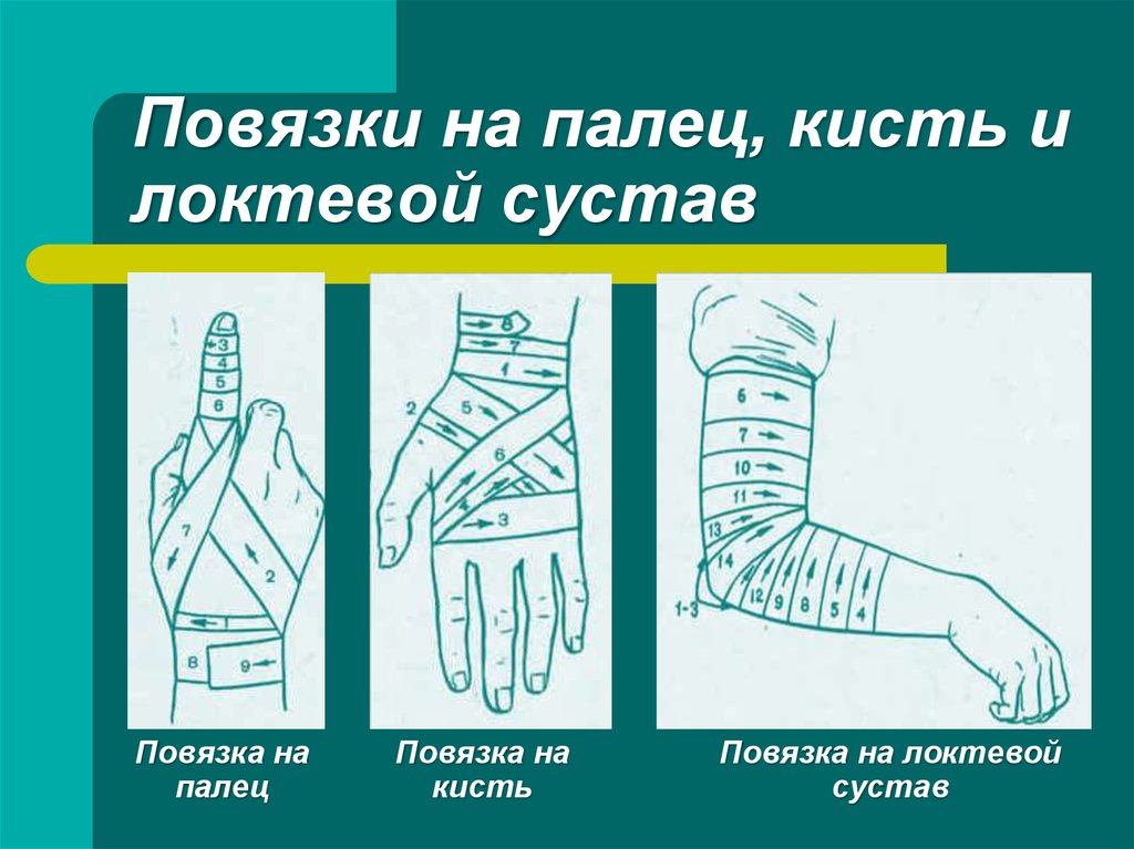 Перевязка локтя. Спиральная повязка на локоть. Спиральная повязка на локтевой сустав. Наложение повязки на локоть. Крестообразная повязка на палец.