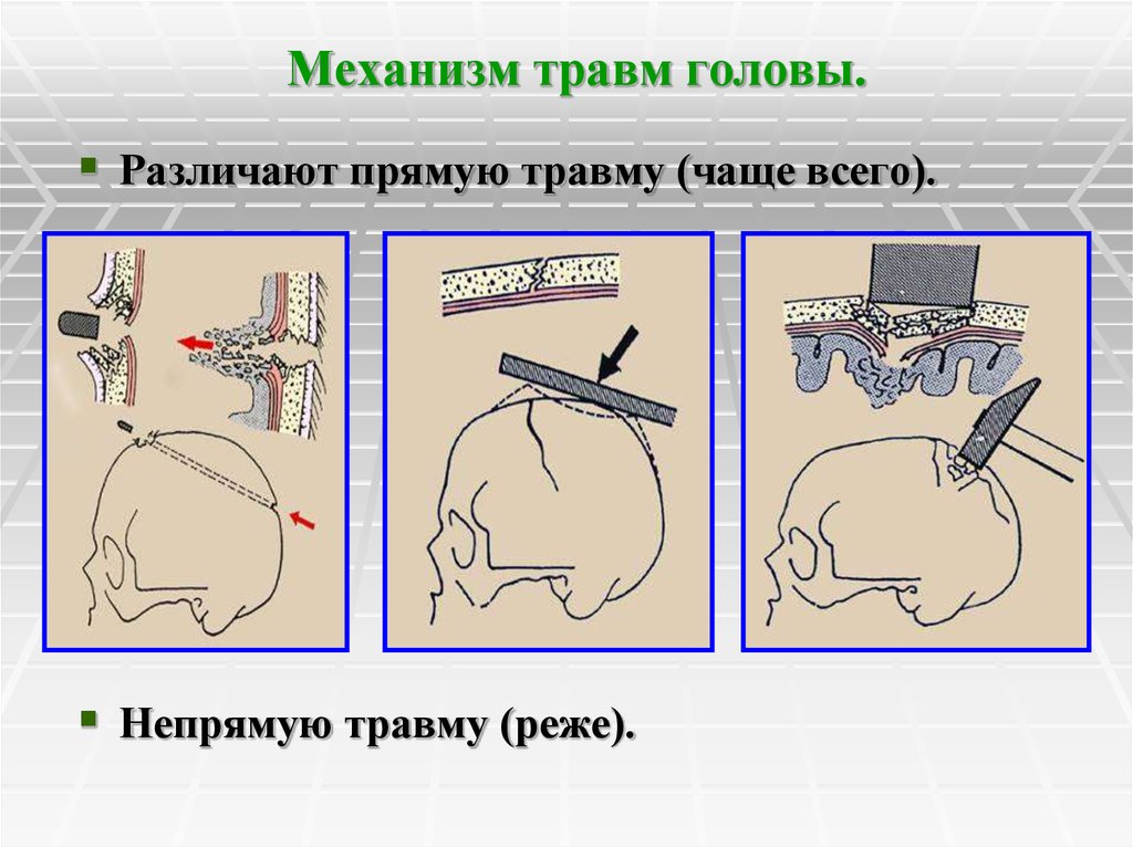 Ранения травмы головы. Прямые и непрямые повреждения. Хирургические заболевания головы. Непрямой механизм травмы. Прямые и непрямые механизмы травмы.