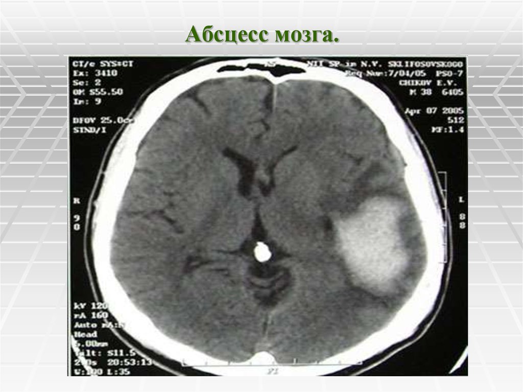 Абсцесс мозга симптомы. Абсцесс головного мозга РКТ. Кт при абсцессе головного мозга.