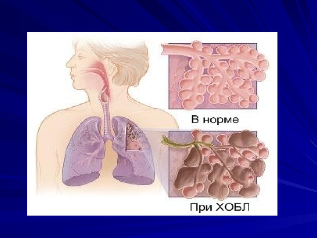 Карта сестринского ухода по педиатрии заполненная бронхит