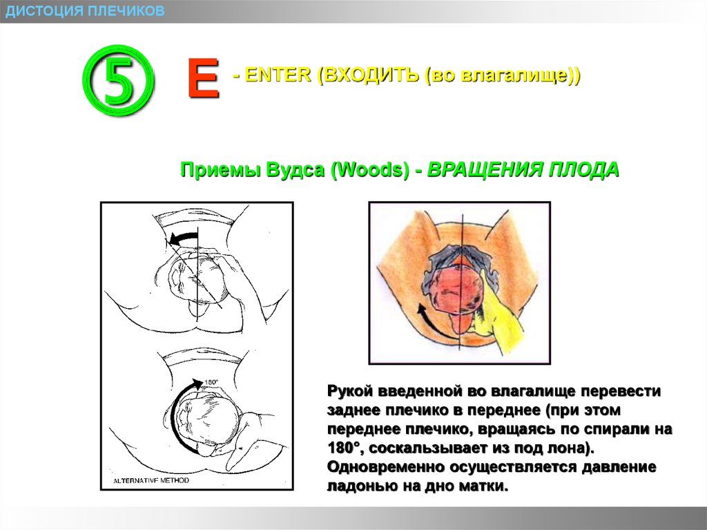 Дистоция плечиков плода