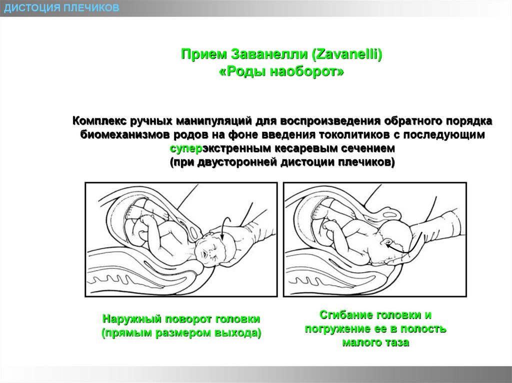 Рождение нижней. Дистоция плечиков клинические рекомендации. Дистоция плечиков прием Мак Робертса. Прием Вудса при дистоции плечиков. Прием Рубина при дистоции плечиков.