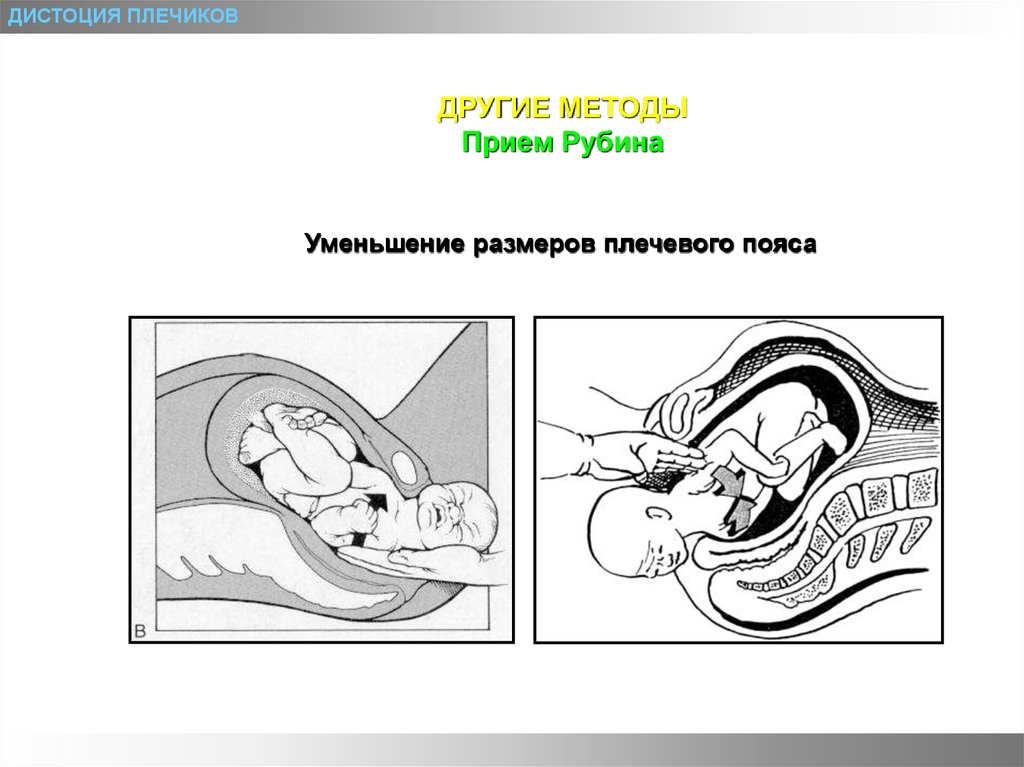 Дистоция плечиков презентация