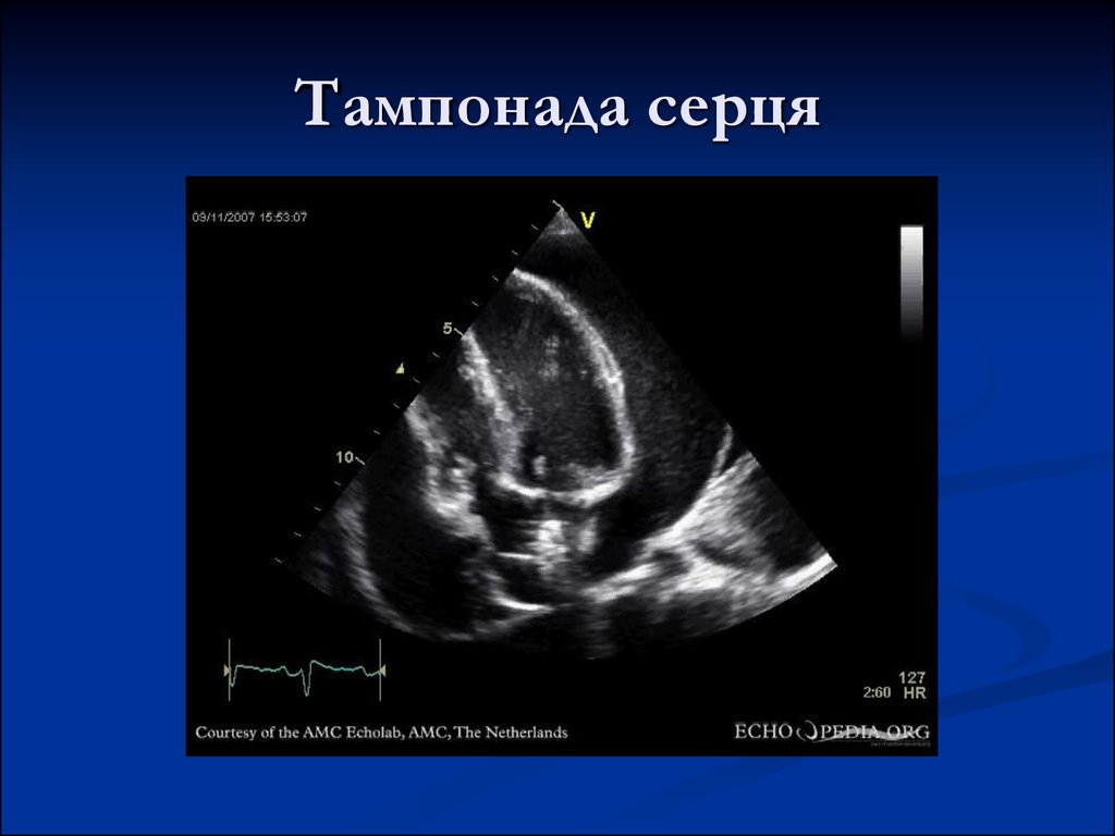 Тампонада сердца презентация