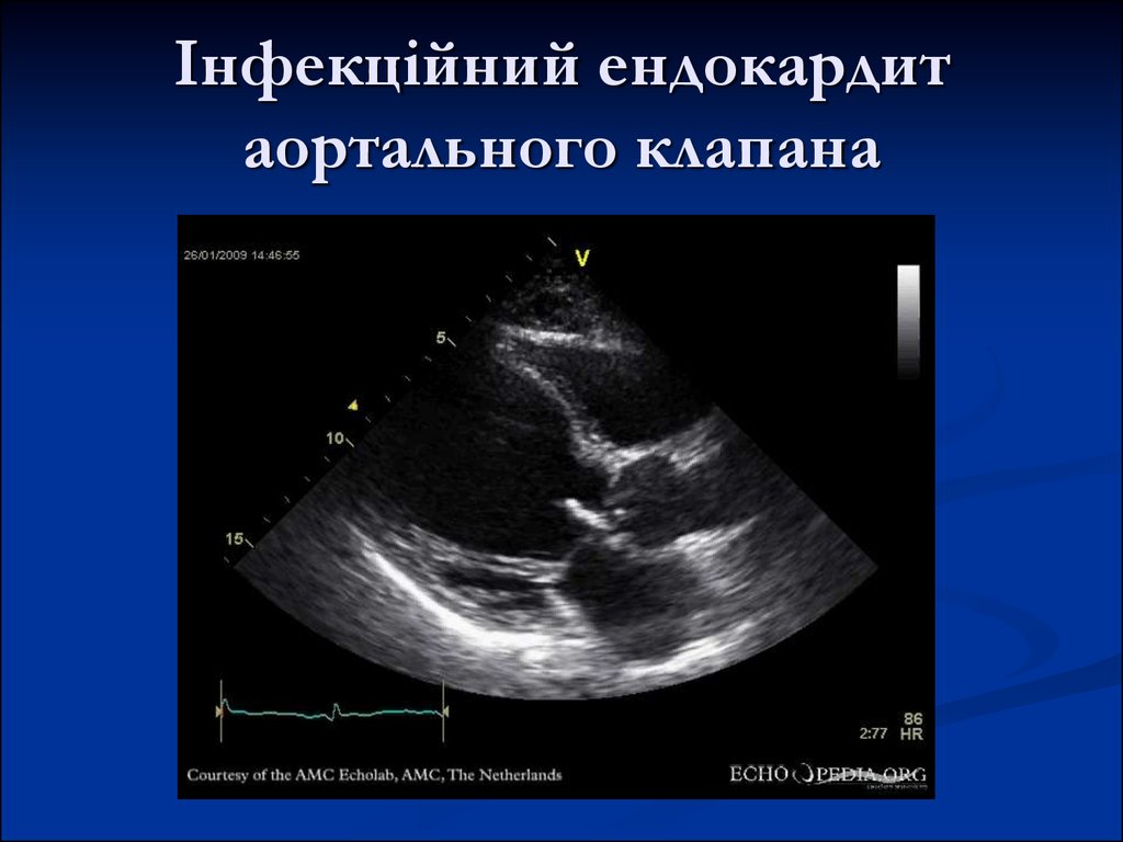 Клапан аорты створки уплотнены