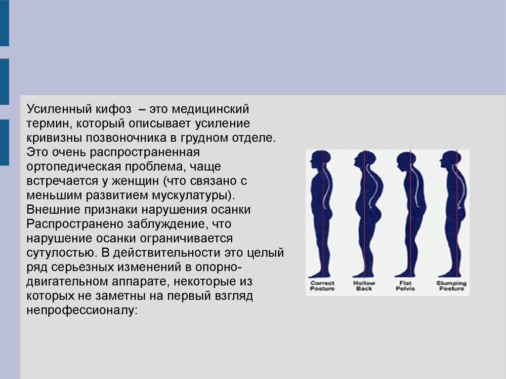 Кифоз что это. Усиление грудного кифоза. Усиленный кифоз. Усиленный грудной кифоз.