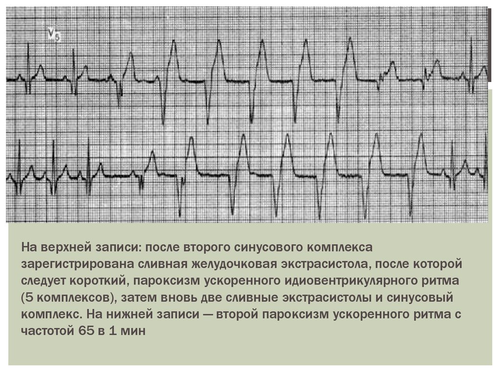 Верхняя запись. Сливные желудочковые экстрасистолы на ЭКГ. Желудочковые экстрасистолы на ЭКГ. Синусовый желудочковый ритм. Групповые желудочковые экстрасистолы на ЭКГ.