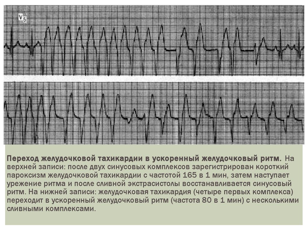 Верхняя запись. Синусовый ритм желудочковый ритм. Пароксизмальная экстрасистолия ЭКГ. Веретенообразная желудочковая пароксизмальная тахикардия. Желудочковый ритм на ЭКГ.