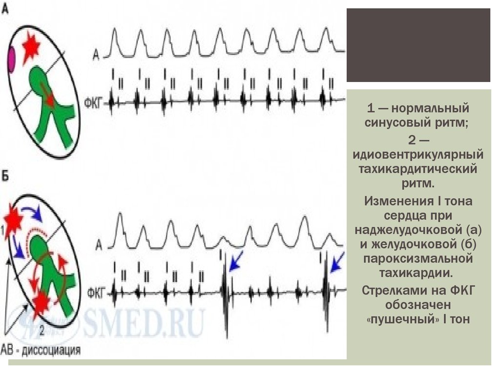 Аритмичные тоны сердца. Пушечный тон сердца. Тоны сердца при пароксизмальной тахикардии. Желудочковые нарушения ритма.