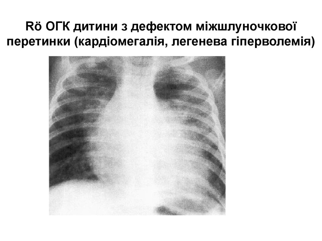 Rö ОГК дитини з дефектом міжшлуночкової перетинки (кардіомегалія, легенева гіперволемія)