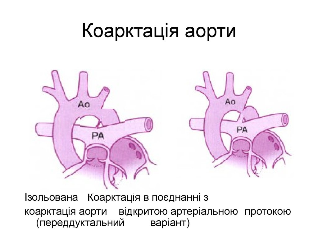 Коарктація аорти