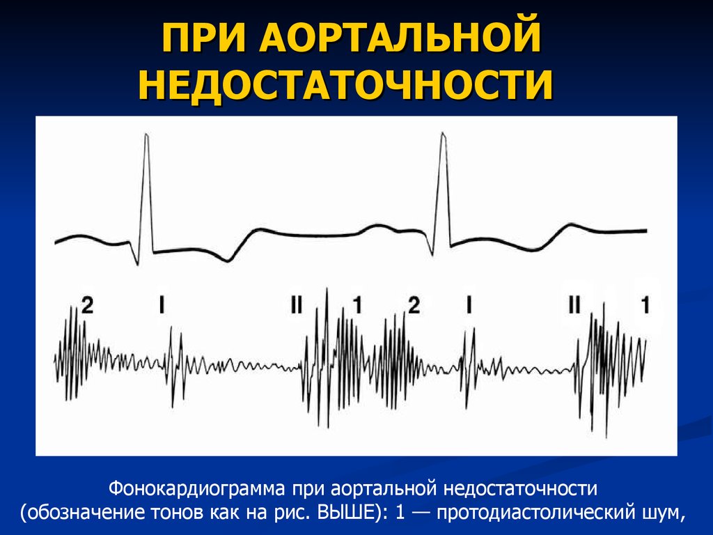 Аускультативная картина недостаточности митрального клапана