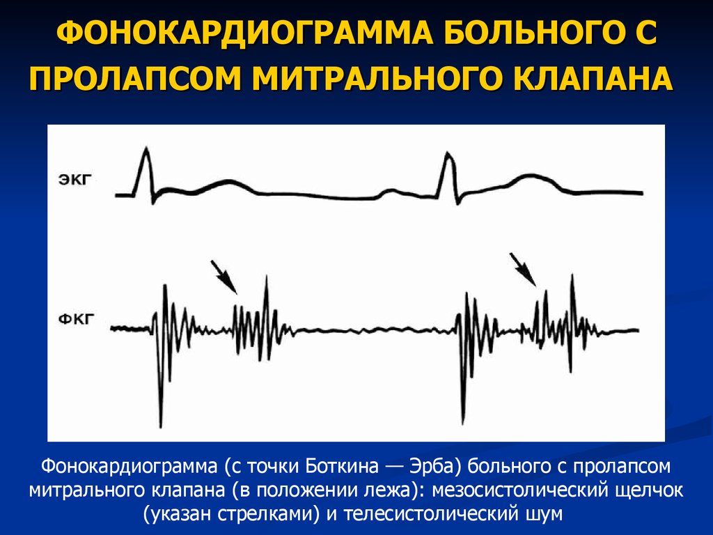 Экг при пролапсе митрального клапана фото