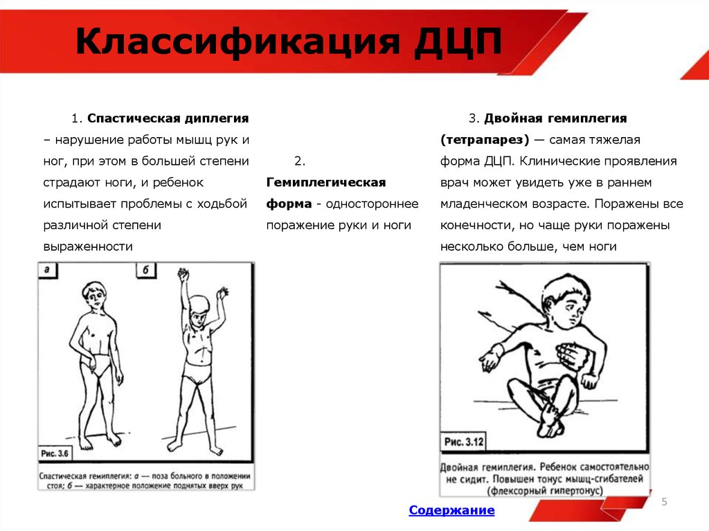 Детский церебральный паралич классификация