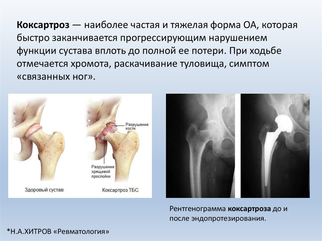 Коксартроз 2 степени симптомы. Коксартроз классификация. Коксартроз исследования.