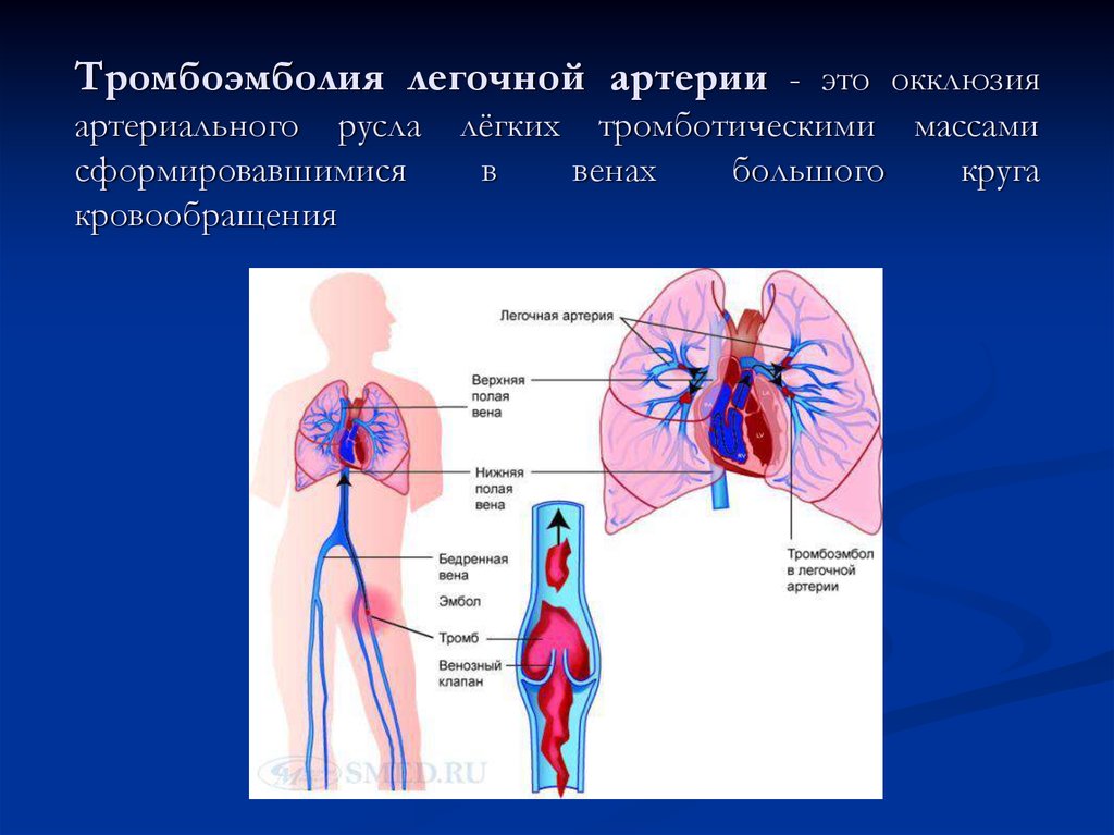 Артериальная тромбоэмболия. Легочная артерия. Тромбоэмболия легочной артерии. Легочные сосуды. Человек с тромбоэмболией легочной артерии.