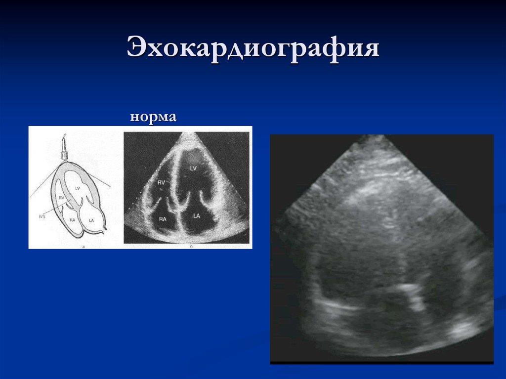 Эхокардиография сердца это. Тромбоэмболия легочной артерии на ЭХОКГ. Эхокардиография при Тэла. Легочная артерия на ЭХОКГ.