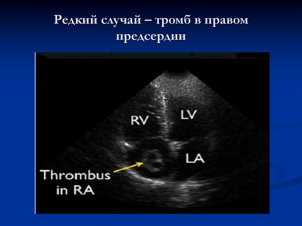 Сердечный тромбоз. Тромб правого предсердия ЭХОКГ. Флотирующий тромб правого предсердия. Тромбоэмболия легочной артерии УЗИ. Тромб в правом предсердии кт.