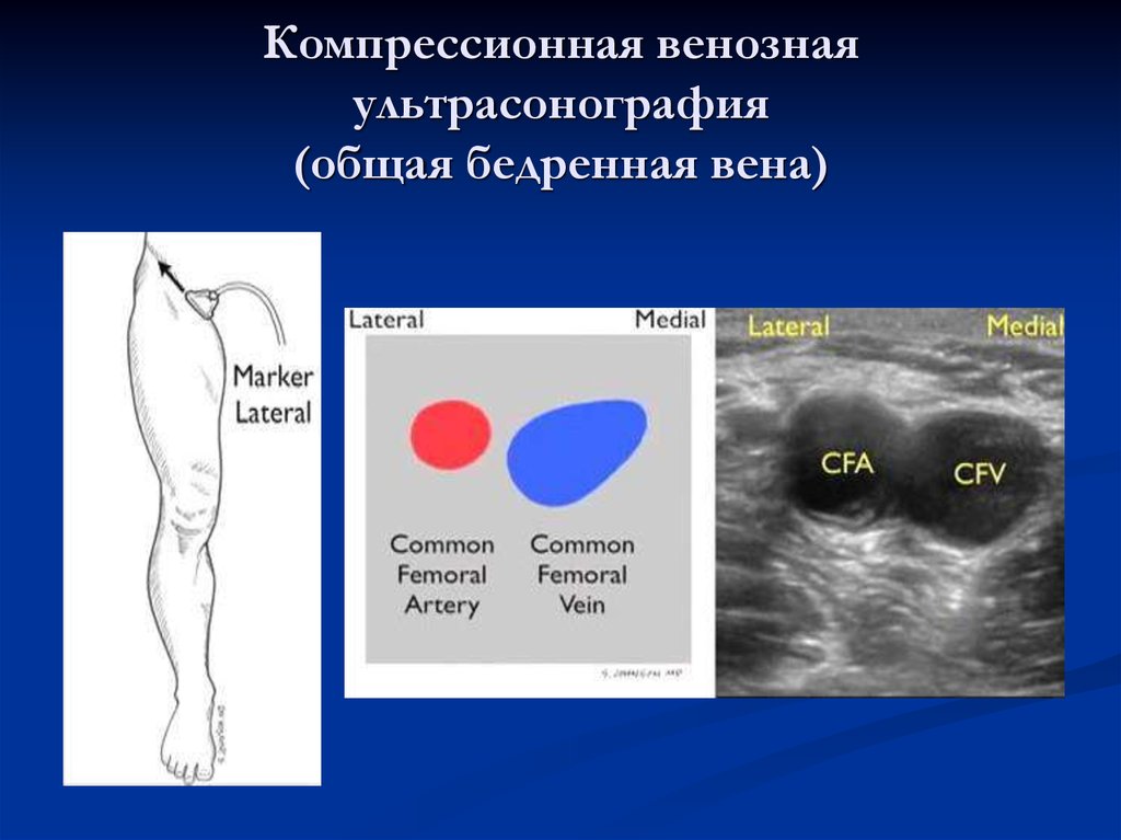Венозная компрессия