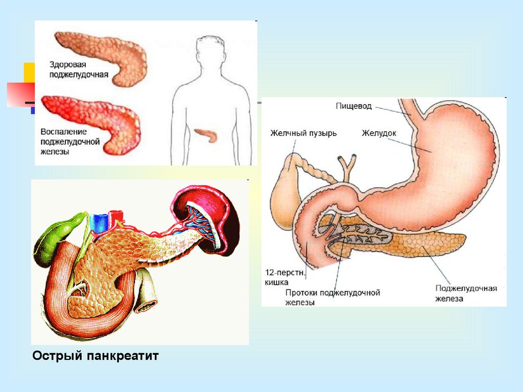 Желудок и поджелудочная. Острый панкреатит поджелудочной железы. Острый панкреатит поджелудочная железа воспаление. Острый панкреатит хронический панкреатит. Острый панкреатит анатомия поджелудочной железы.