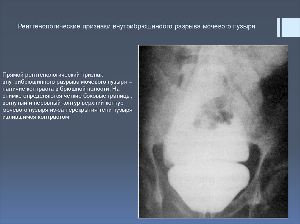 Рентгенологические признаки. Цистография разрыв мочевого пузыря. Внебрюшинный разрыв мочевого пузыря рентген. Внутрибрюшинный разрыв мочевого пузыря рентген. Внутрибрюшинный разрыв мочевого пузыря на цистографии.