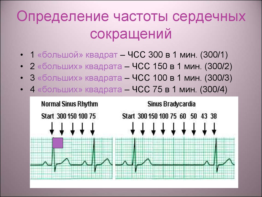 Измерение средней частоты. Как определяется частота пульса. Измерение ЧСС по ЭКГ 10 мм. Как узнать частоту пульса. Как рассчитать частоту пульса.