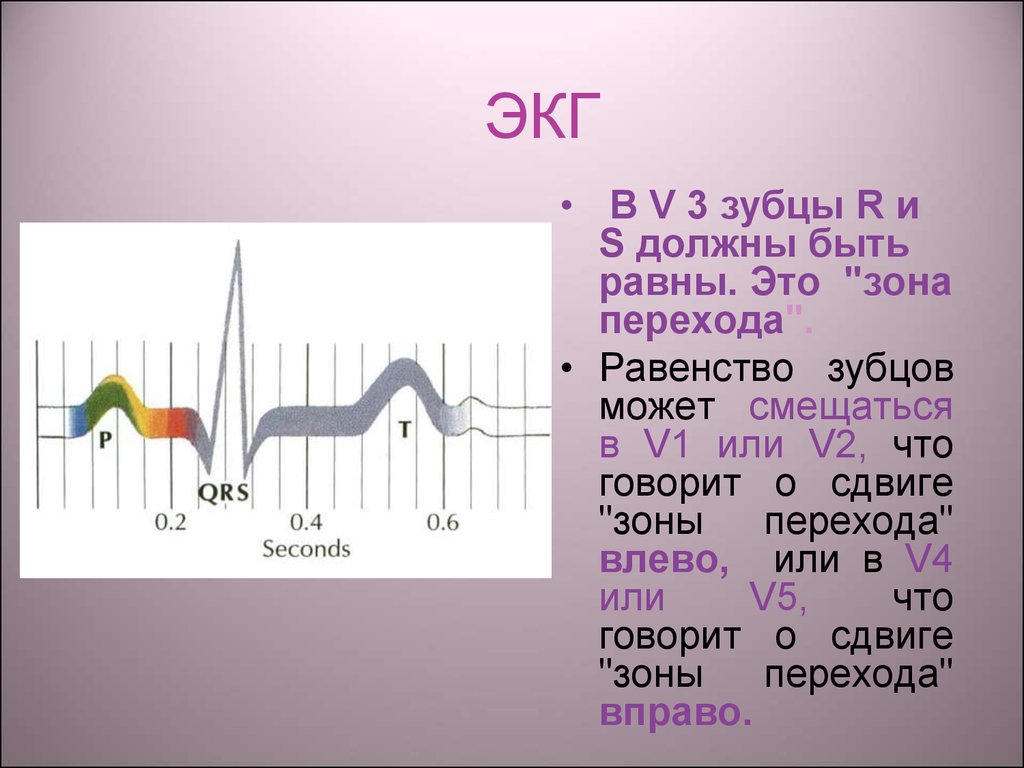 R v 3. Переходная зона v2-v3 на ЭКГ. ЭКГ сердца переходная зона:v2-v3. Переходная зона на ЭКГ v3 v4 что это. Переходная зона на ЭКГ В норме.