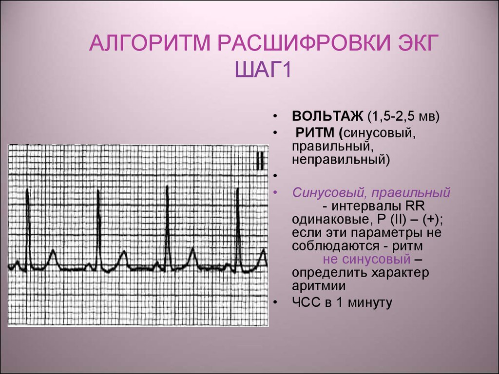 Экг со скольки. Показатели электрокардиограммы сердца норма. Как выглядит расшифровка ЭКГ. ЭКГ норма расшифровка кардиограммы. QRS 0.07 на ЭКГ.