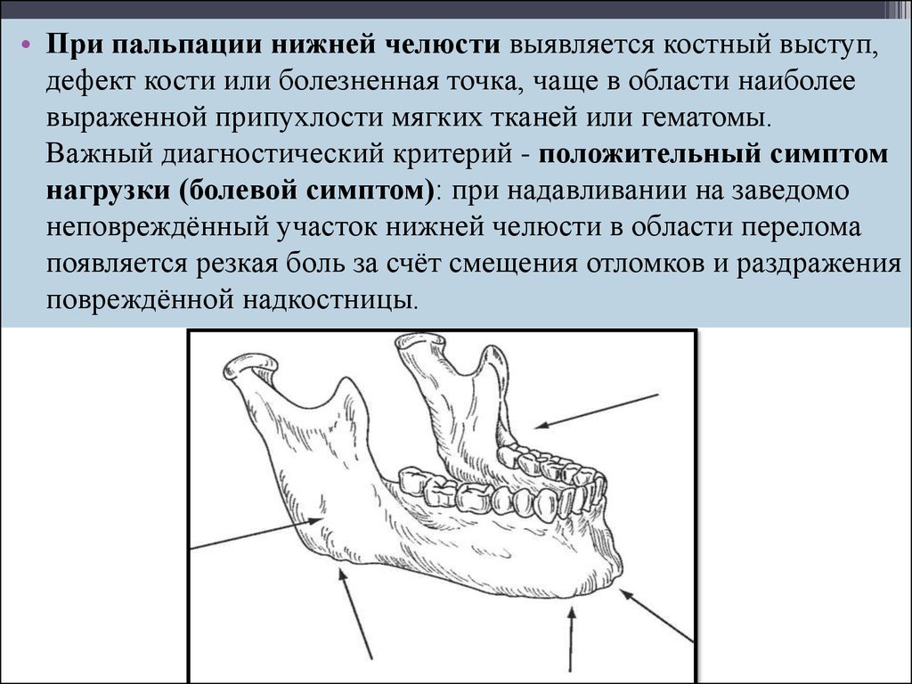 Сильнейшая боль нижней челюсти. Изоляция костных выступов верхней и нижней челюсти. Двойной перелом нижней челюсти. Нижняя челюсть кость. Костные выступы в челюсти.