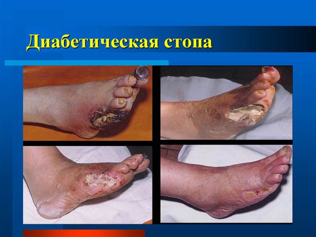 Диабетическая стопа