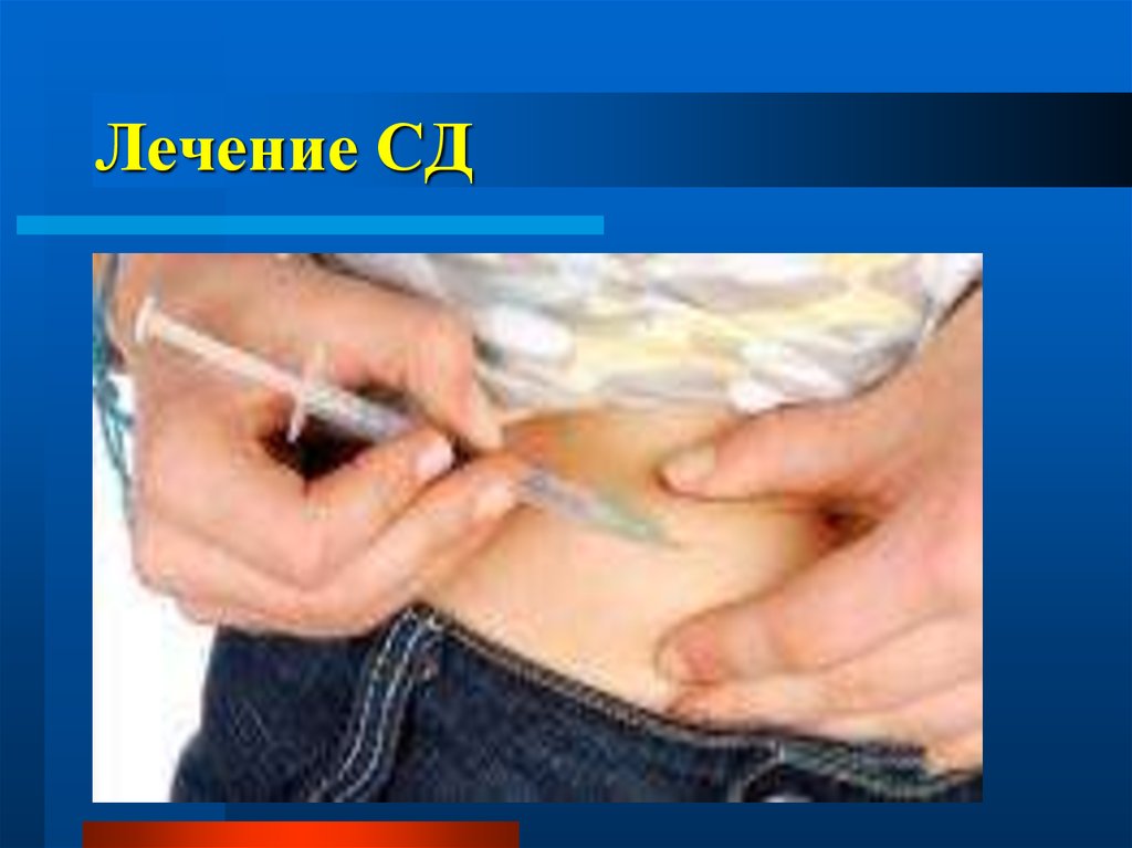 Лечение СД
