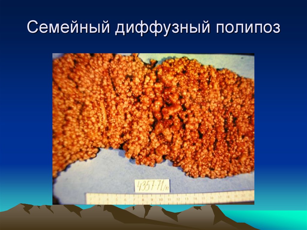 Диффузный полипоз толстой кишки. Диффузный полипоз ободочной кишки. Семейный диффузный полипоз кишечника. Семейный полипоз толстой кишки макропрепарат. Диффузный семейный полипоз.