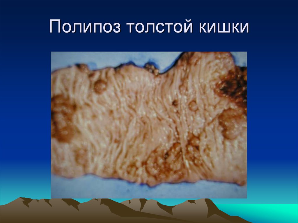 Полипоз толстой кишки