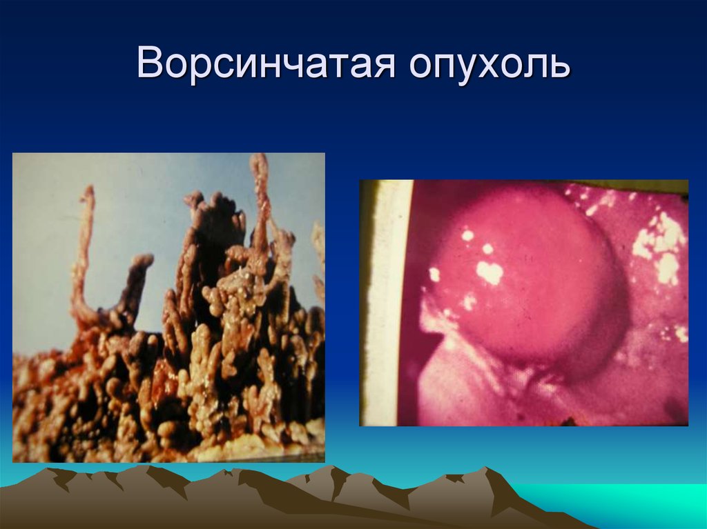 Ворсинчатая опухоль