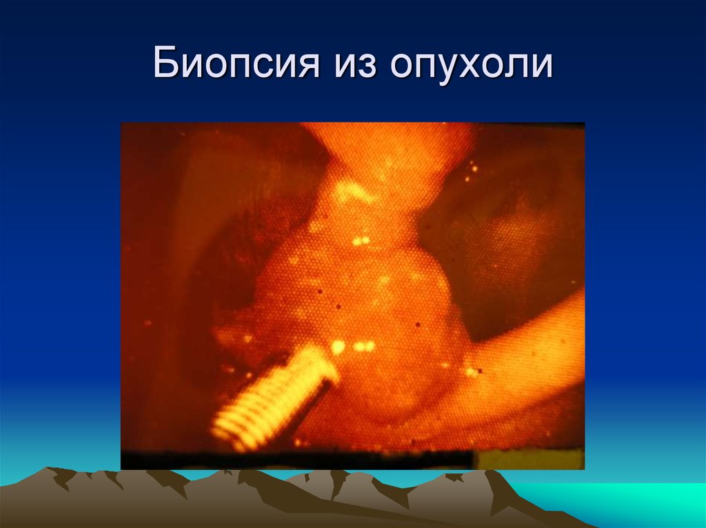 Биопсия из опухоли