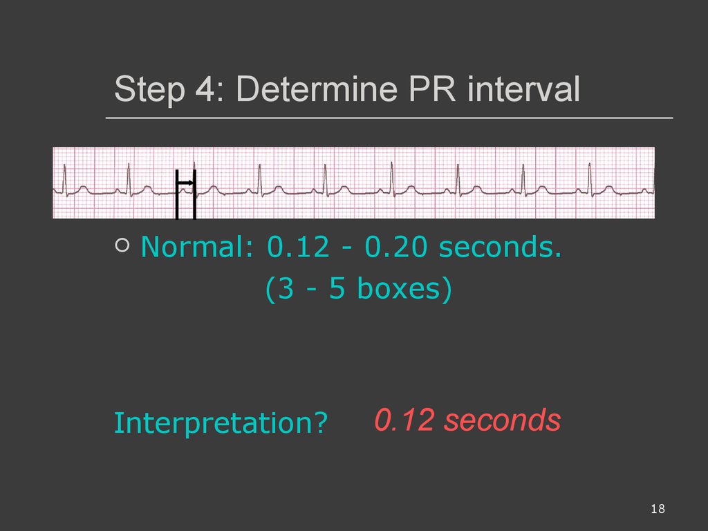 Step 4: Determine PR interval