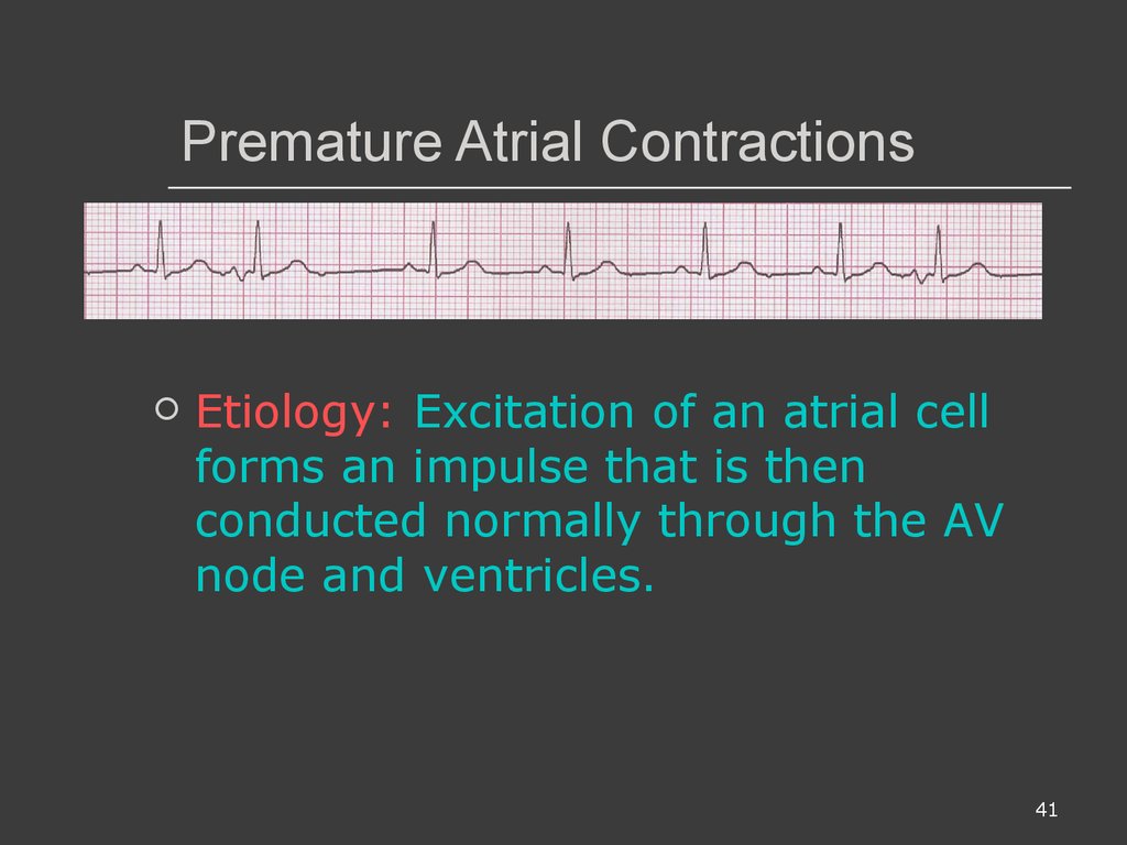 Premature Atrial Contractions