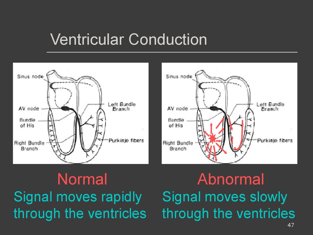 Ventricular Conduction